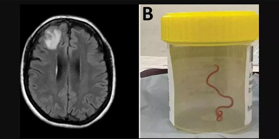 विश्वमै पहिलोपटक भेटियो मस्तिष्कमा जीवित कीरा